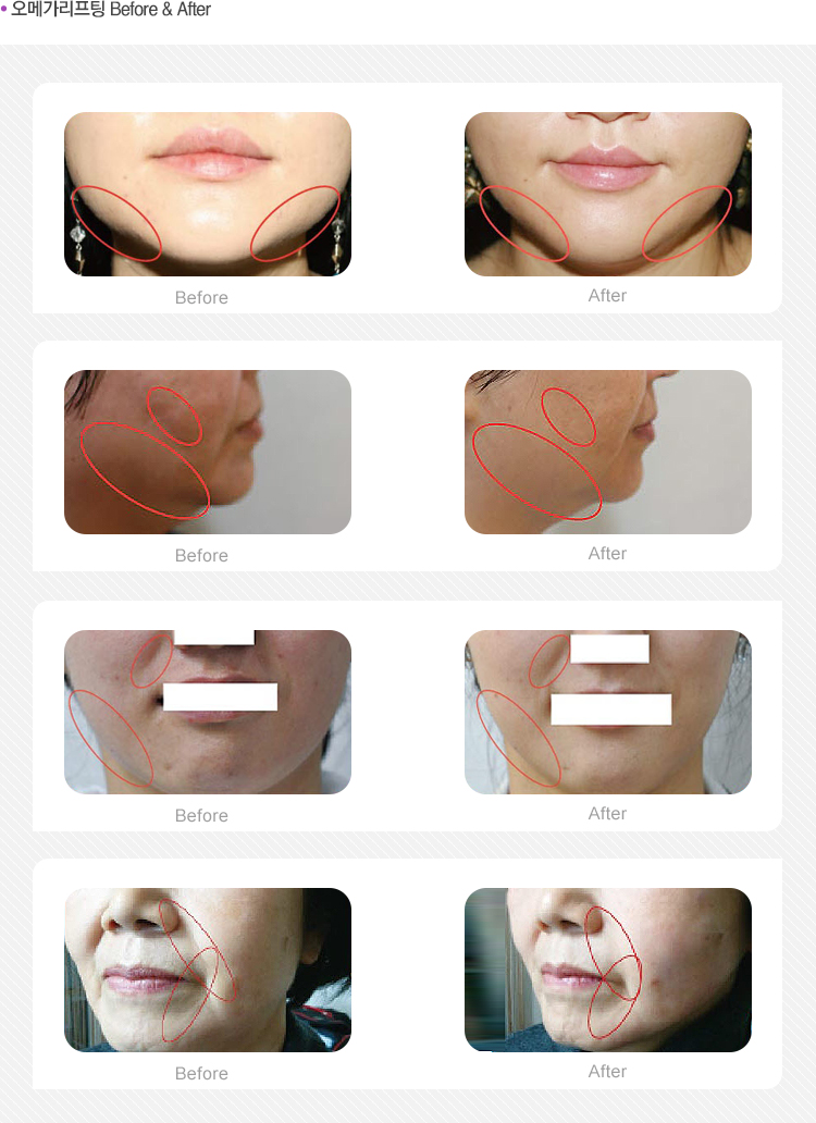 Ŀ Before & After